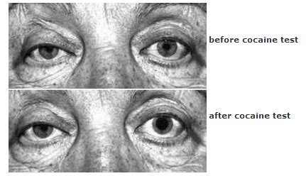 cocaine drop test|When Anisocoria Signals A Bigger Problem.